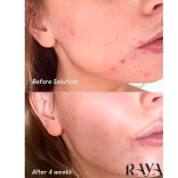 ژل شستشوی ضد جوش کلینیک حجم 30 میل